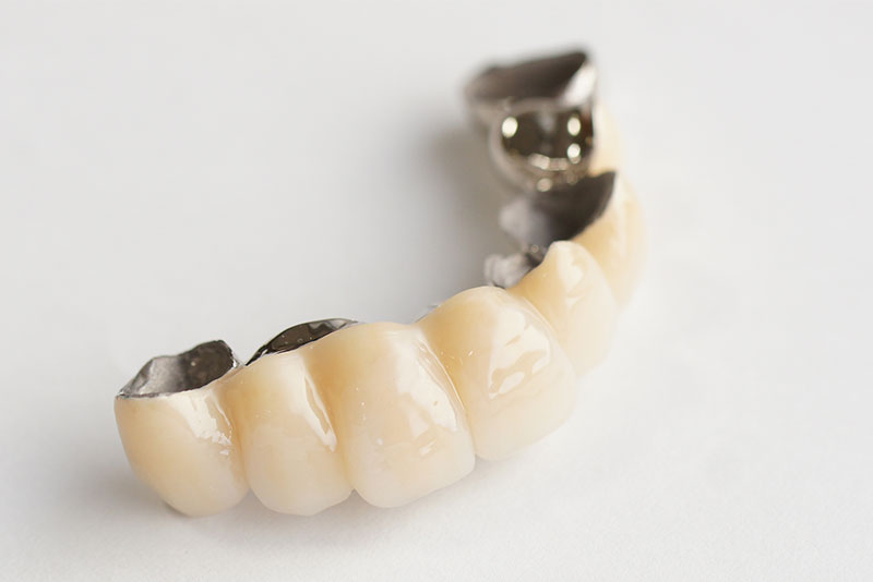 保険診療のブリッジの場合