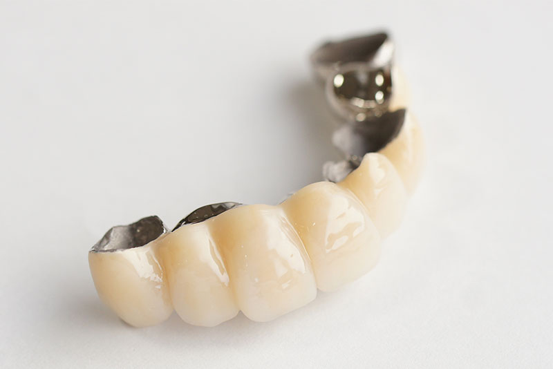 レジン前装冠ブリッジ