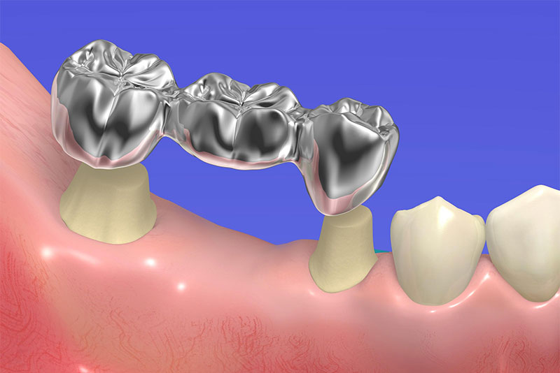 金銀パラジウムブリッジ