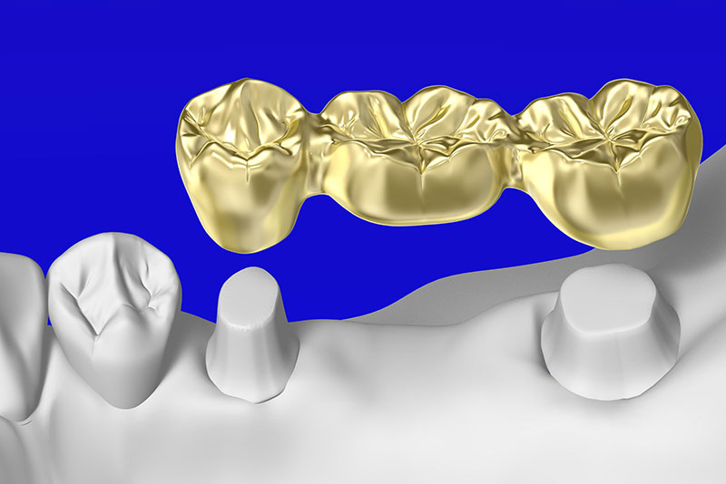 ゴールドブリッジ