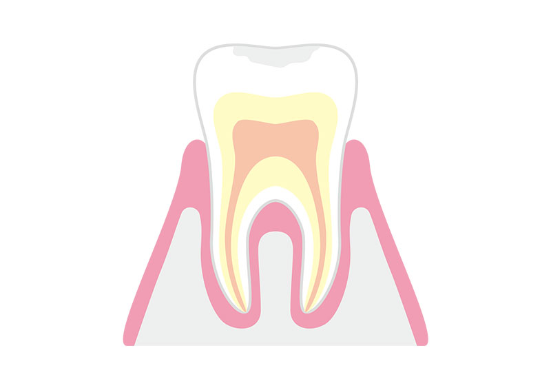 CO（初期むし歯）