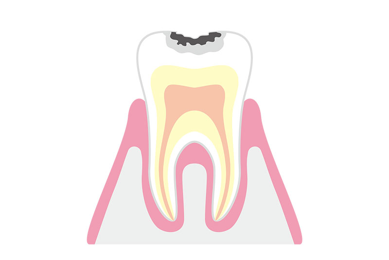 C1（エナメル質のむし歯）