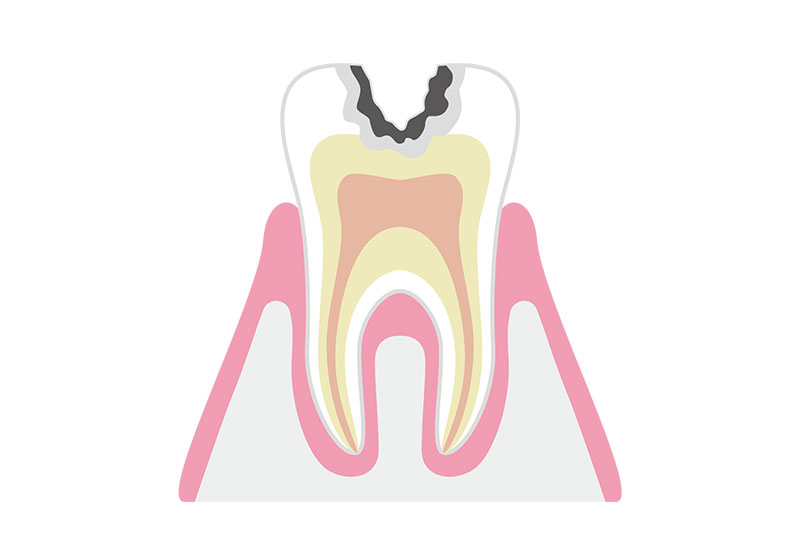 C2（象牙質まで進んだむし歯）