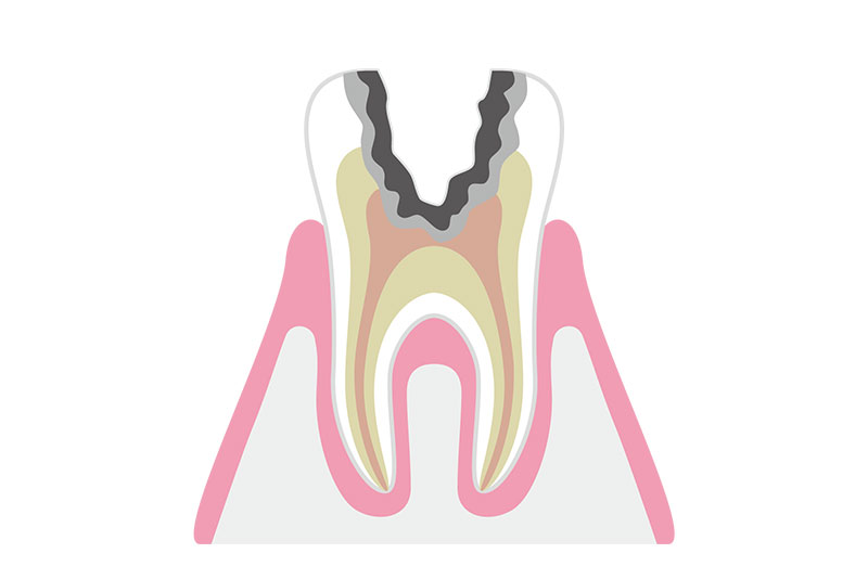 C3（神経まで進んだむし歯）