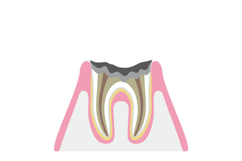 C4（歯の根だけが残ったむし歯）