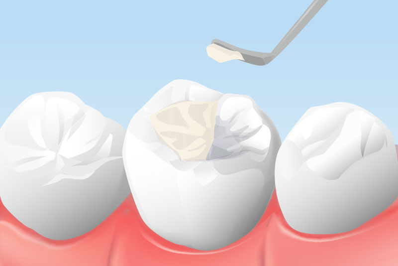 コンポジットレジン