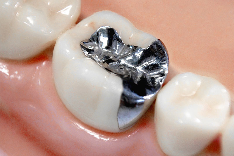 金属製の詰め物・被せ物