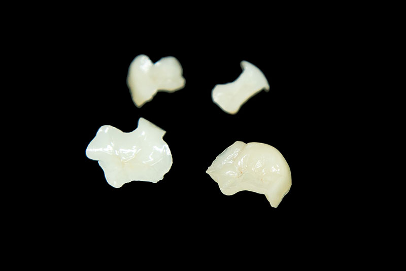 e-maxインレー・クラウン