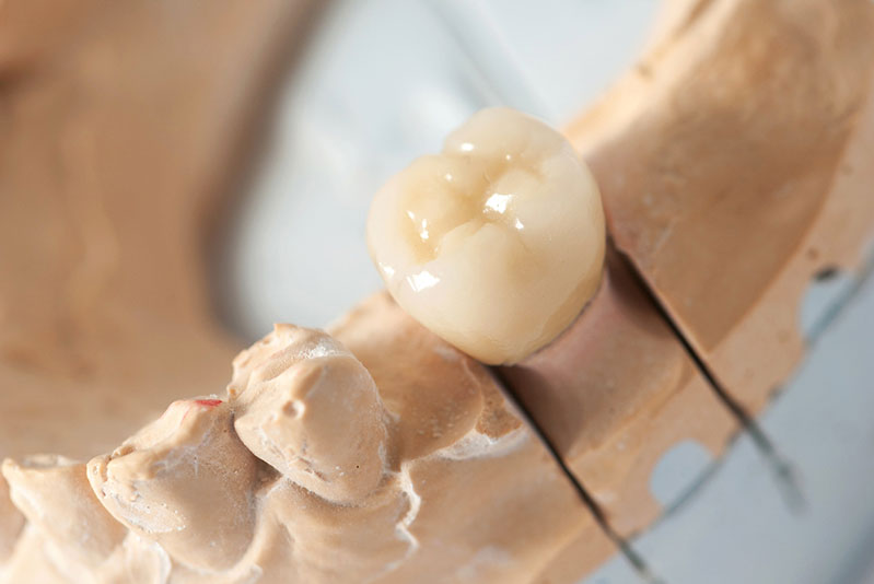 ジルコニアインレー・ジルコニアクラウン