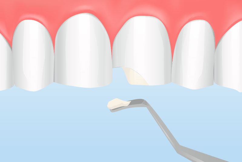 ダイレクトボンディング