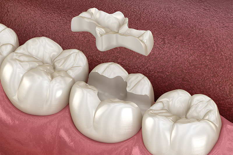 インレー・アンレー・クラウン修復