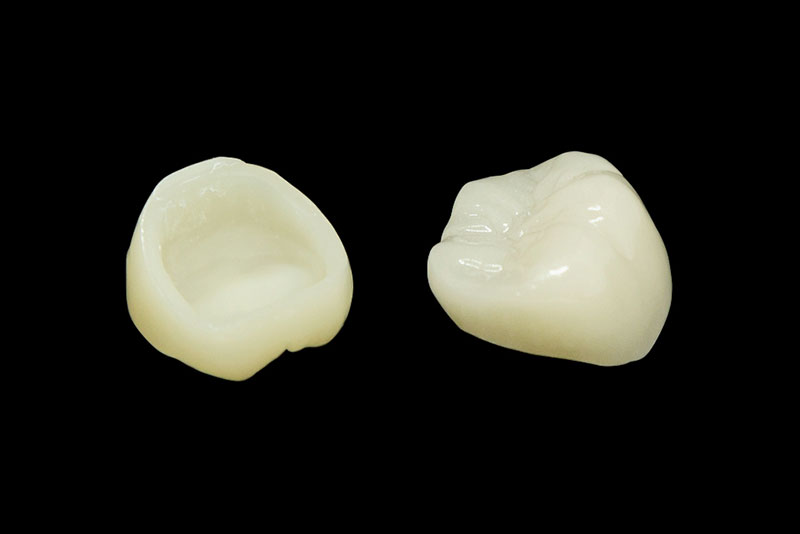 保険適用の白い歯：CAD/CAM冠とは