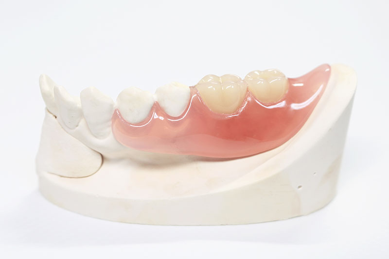 ノンクラスプデンチャー