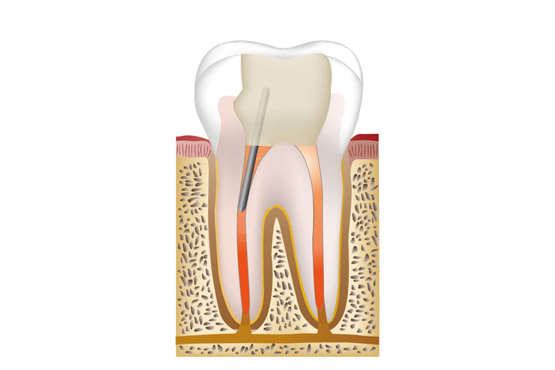 土台作り・型取り