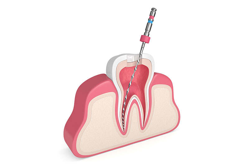 根管治療の種類