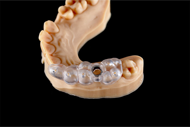 サージカルガイドとは