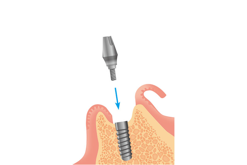 アバットメントの装着（2次手術）