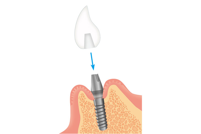 最終上部構造（人工歯）の装着