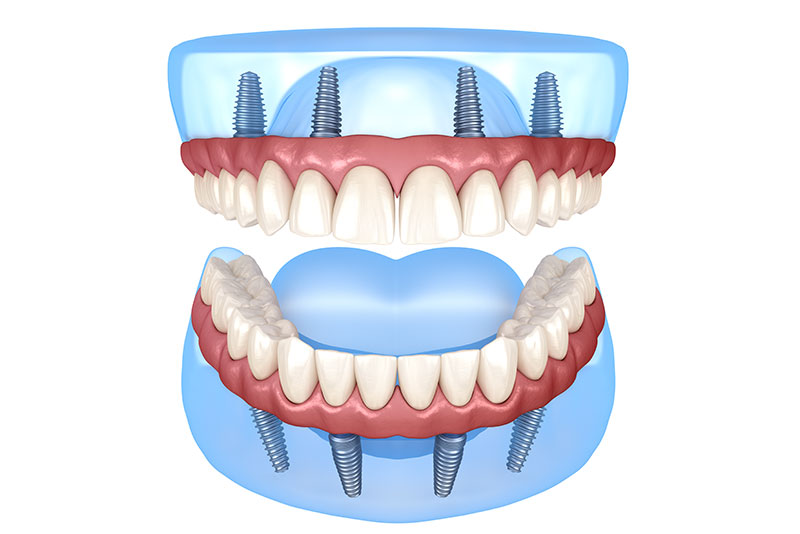 オールオン4・オールオン6とは