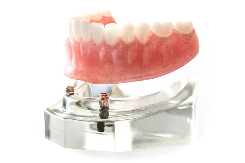 インプラントオーバーデンチャーとは