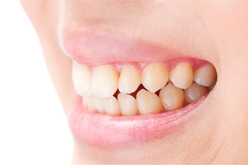 歯ぎしり・食いしばりへの対策