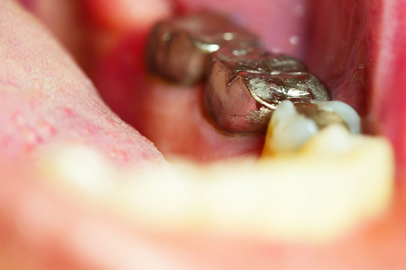 メタルフリー治療とは