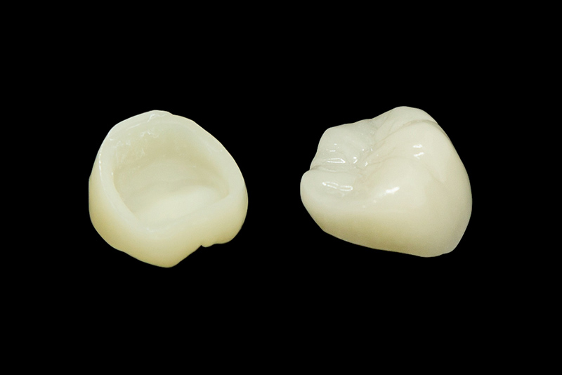 保険適用で受けられるメタルフリー治療：CAD/CAM冠