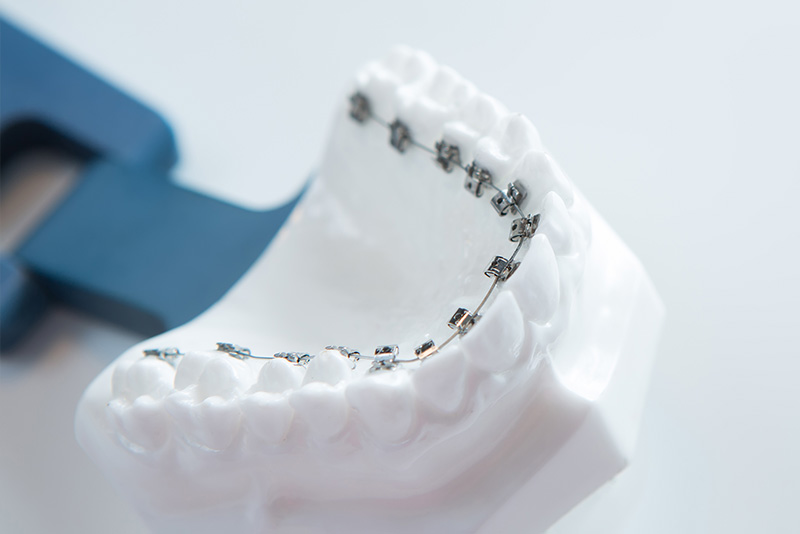 裏側矯正（リンガルブラケット矯正）