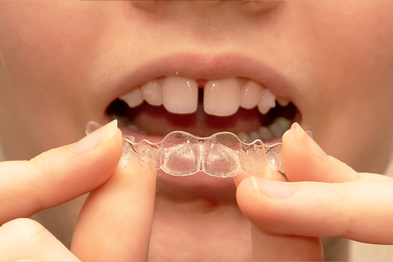 「インビザライン・ファースト」子どものマウスピース矯正治療