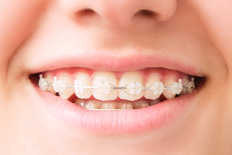 子どものワイヤー矯正