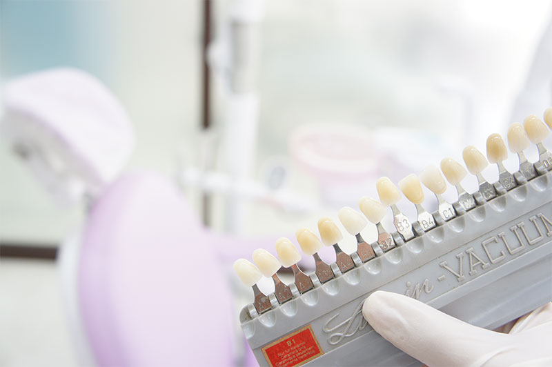 ホワイトニングを始めるタイミング