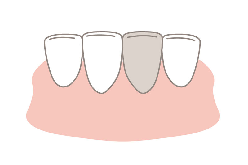 失活歯のホワイトニング：ウォーキングブリーチ